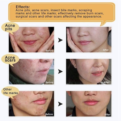 Picture of LanBeNa - TCM Acne Scar Removal Cream Skin Repair Face Cream for Burns Cuts Operation Stretch Mark Remover Acne Scar Treatment-30gm