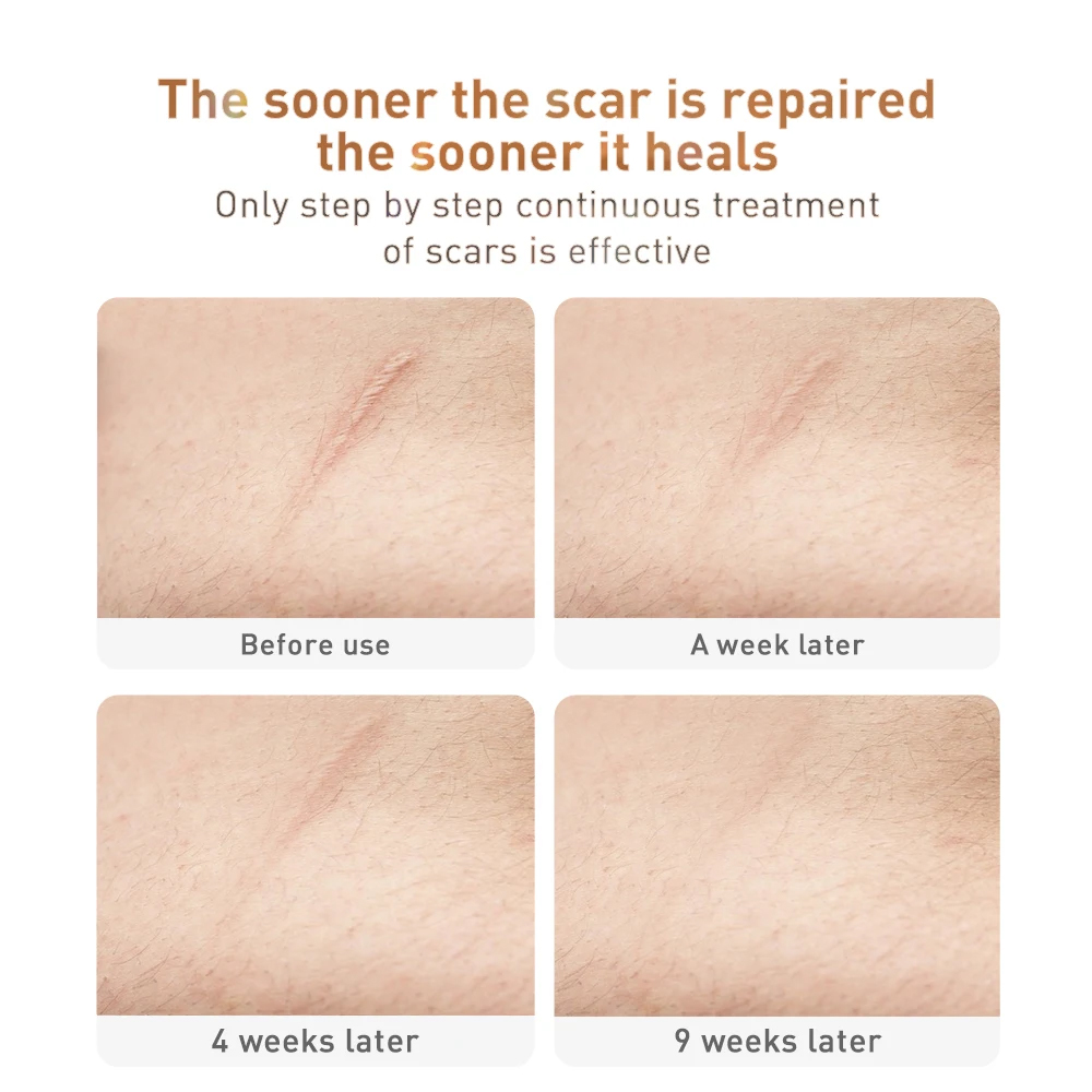 Picture of Lanbena Tcm Scar And Acne Removal Gel Ointment 30G