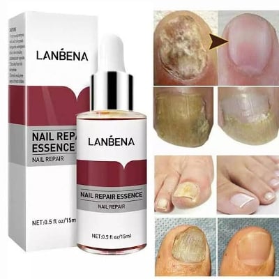 Picture of Lanbena Nail Fungal Treatment Remove Paronychia Onychomycosis Toe Nail Repairing,Treatment Toe Nail Repair Essence Nail Solution-15Ml