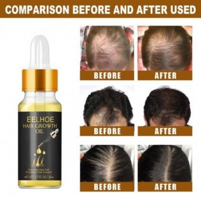Picture of Eelhoe Hair Essential Oil for Scalp & Hair Care-20gm