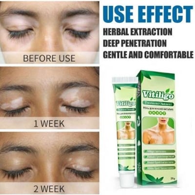 Picture of Sumifun Vitiligo Cream Reduces White Spots and Improves Skin Pigmentation-20gm