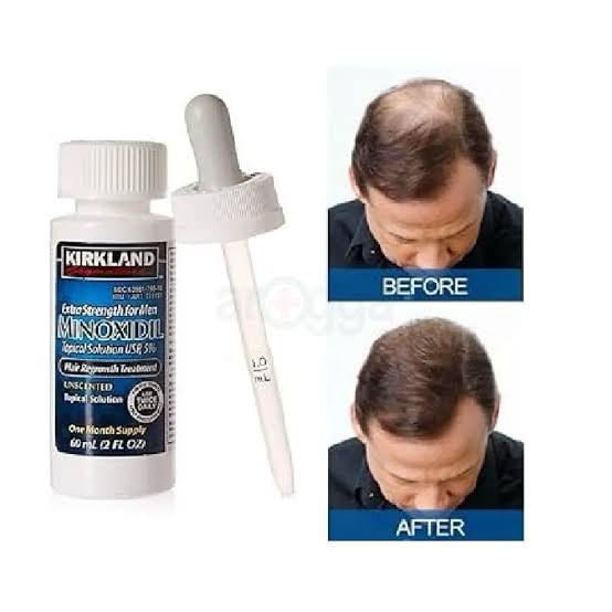 Picture of Kirkland Minoxidil 5% Topical Solution 60ml Extra Strength Hair Regrowth Treatment for Men Dropper Applicator Included 2026 new new(Glow N Touch Beauty)