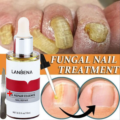 Picture of LANBENA Nail Repair Essence Serum Fungus Treatment Nail Removal Onychomycosis-15ml  new(Glow N Touch Beauty)