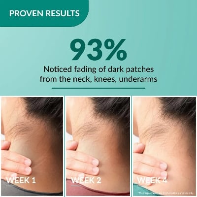 Picture of Fixderma Nigrifix Cream for Acanthosis Nigricans with Lactic Acid - 50g neew