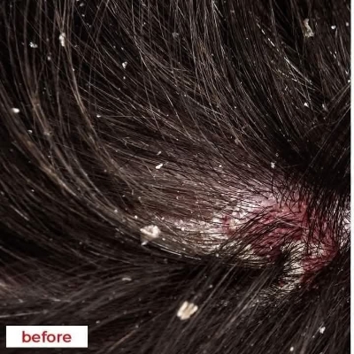 Picture of Nizoral 2% Ketoconazole Hair Care Anti-Dandruff Shampoo 100ml - Multicolor