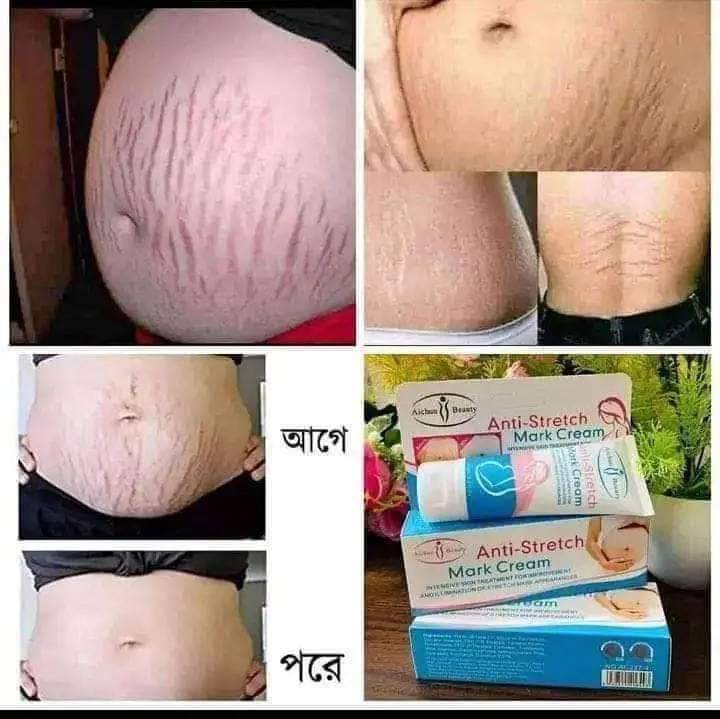 Picture of Aichun Beauty Anti-Stretch Marks Cream | Stretch Marks Removal Cream 60gm