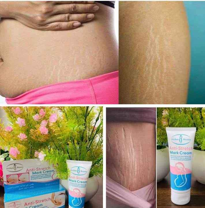 Picture of Aichun Beauty Anti-Stretch Marks Cream | Stretch Marks Removal Cream