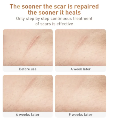 Picture of Lanbena Tcm Scar And Acne Removal Gel Ointment 30G 