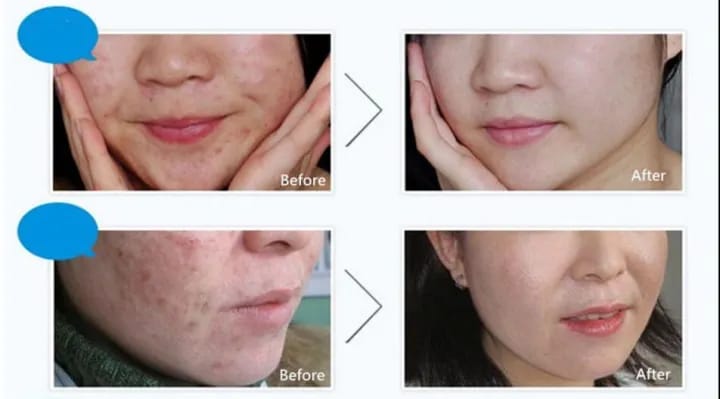 Picture of BIOAQUA Pure Skin Acne Rejuvenation & Cream - 30g 