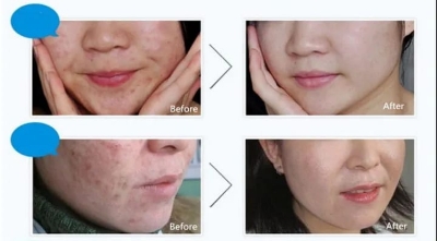 Picture of BIOAQUA Pure Skin Acne Rejuvenation & Cream - 30g 