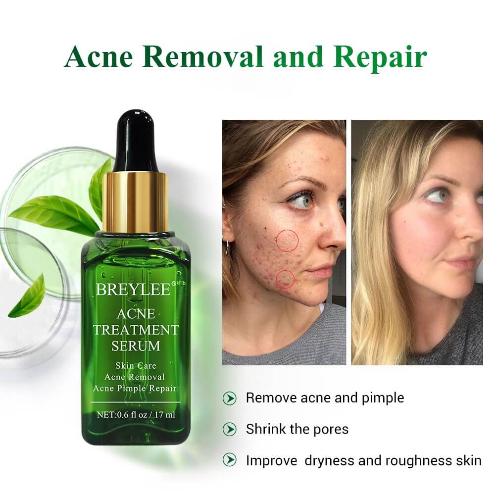 Picture of BREYLEE Acne Treatment Cream and Serum( 20g +17ml) 