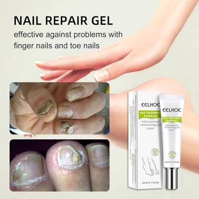 Picture of EELHOE Nail Fungus Repair Essence Gel Nail Treatment Repair Cream Gel-20gm