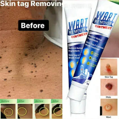 Picture of Wart Remover Ointment 20gm