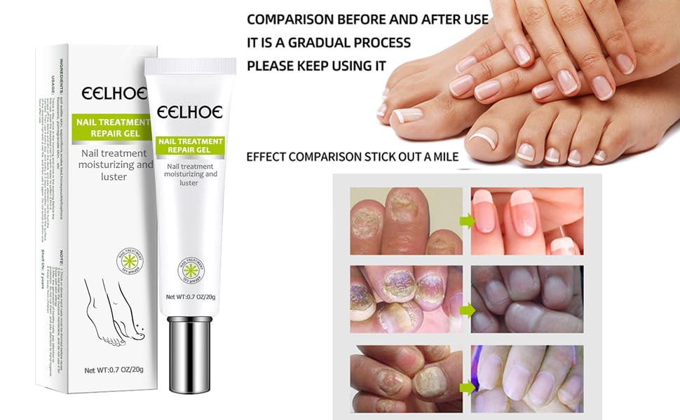 Picture of EELHOE Nail Fungus Repair Essence Gel Nail Treatment Repair Cream Gel-20gm