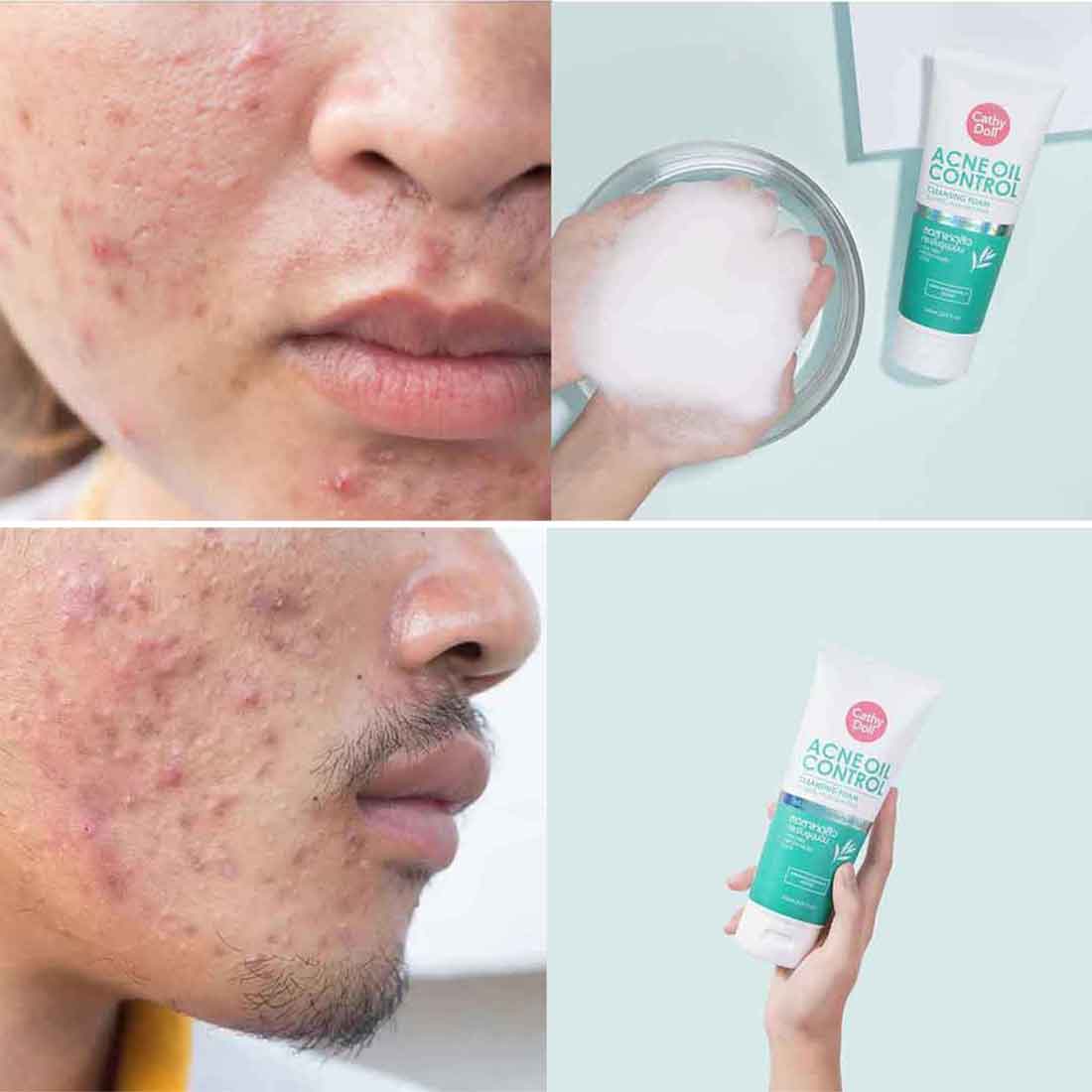 Picture of Cathy Doll Acne Oil Control Cleansing Foam Paraban Free - 150 ml (Thailand)