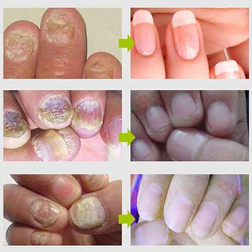 Picture of Efero Nail Repair Treatment Gel Fungus Cream-20gm
