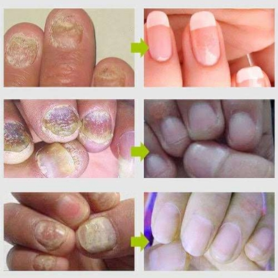 Picture of Efero Nail Repair Treatment Gel Fungus Cream-20gm