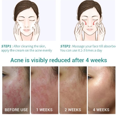 Picture of LAIKOU Oil Control Moisturizing Acne Removal Gel- 20g
