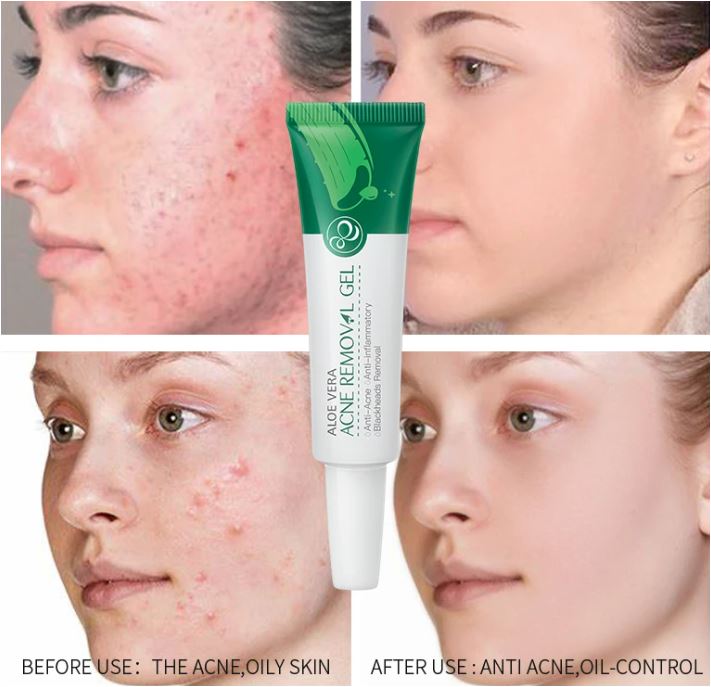 Picture of LAIKOU Oil Control Moisturizing Acne Removal Gel- 20g