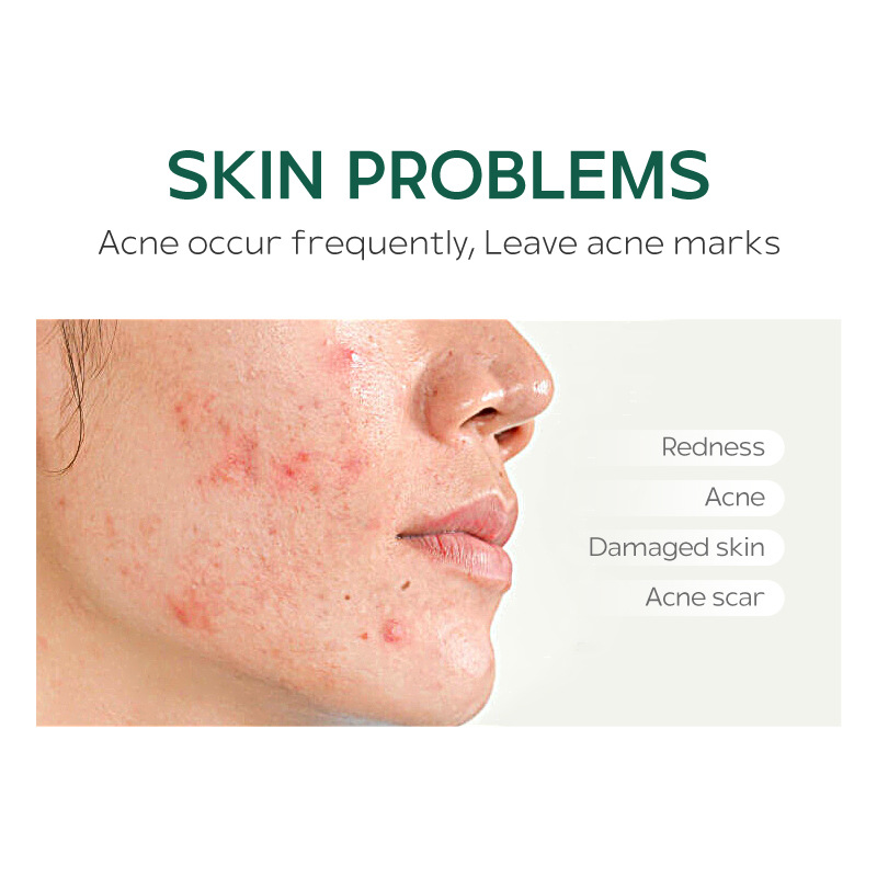 Picture of Laikou 8G Herbal Anti-Acne Cream