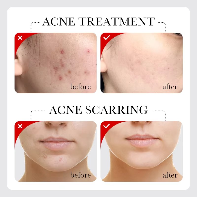 Picture of SADOER Fruit Acid AHA+BHA Acne Repair Serum- 30ml