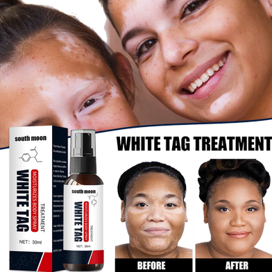 Picture of South Moon White Tag Treatment Vitiligo Therapeutic Serum Universal White Spot Cleansing Spray -30ml