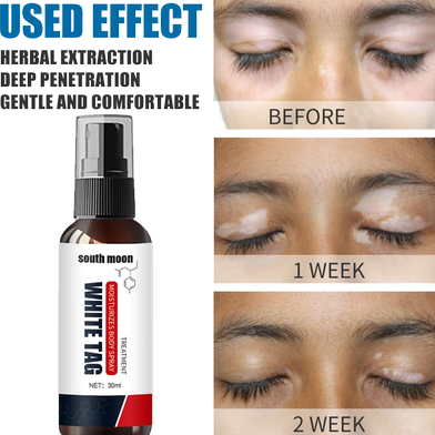 Picture of South Moon White Tag Treatment Vitiligo Therapeutic Serum Universal White Spot Cleansing Spray -30ml