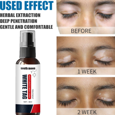 Picture of South Moon White Tag Treatment Vitiligo Therapeutic Serum Universal White Spot Cleansing Spray -30ml