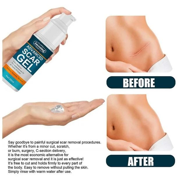 Picture of Jaysuing Advanced Scar Gel, Scar Removal for Surgical Scars, Acne Scar Removal Cream-50gm