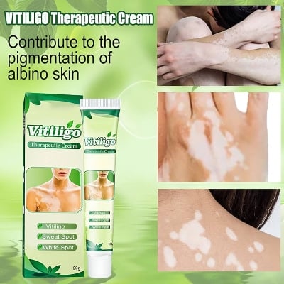 Picture of Vitiligo Treatment Cream Healthy White Spot Therapeutic Gel