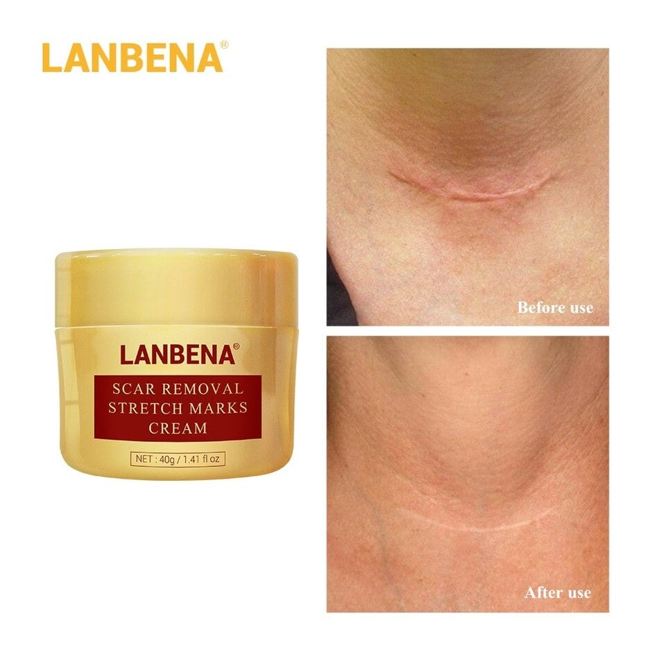 Picture of LANBENA Acne Scar Removal Cream Repair Acne Spots Acne Treatment Blackhead Whitening Shrink Pores Stretch Marks Skin Care 40g