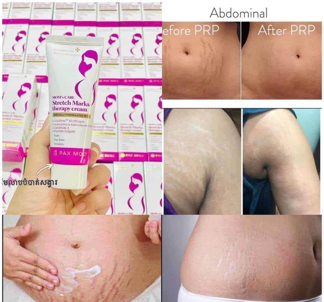 Picture of Pax Moly Mom’s Care Stretch Mark Cream -70ml