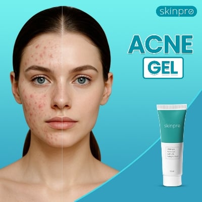 Picture of Buy Skinpro ultimate acne Gel 15ml White