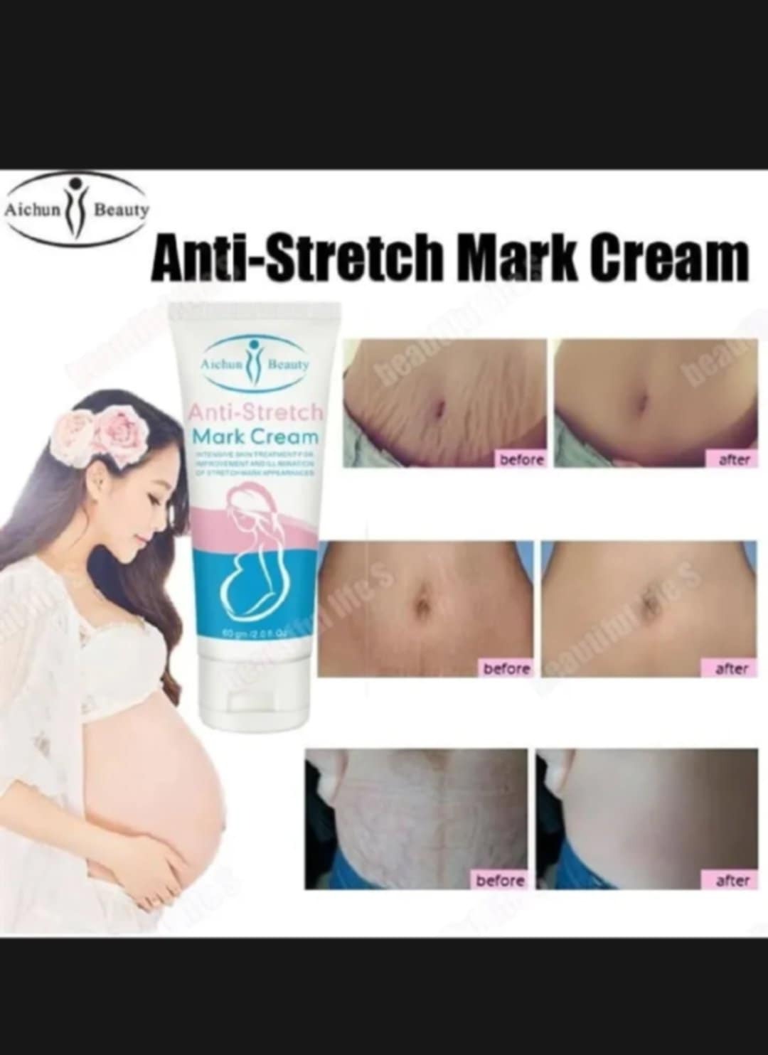 Picture of Aichun Beauty Anti-Stretch Marks Cream | Stretch Marks Removal Cream