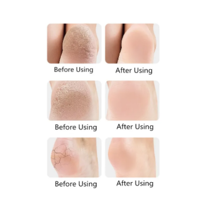 Picture of Silicone Moisturizing Gel Heel Anti-Crack Socks to Eliminate Cracks Feet Skin Care - Multicolor - Int: One size