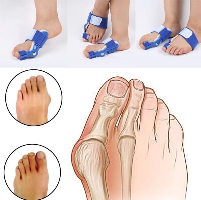 Picture of Bunion Hallux Valgus Orthopedic Braces Toe Correction Night Foot Care Corrector Thumb Daily Big Bone Tools