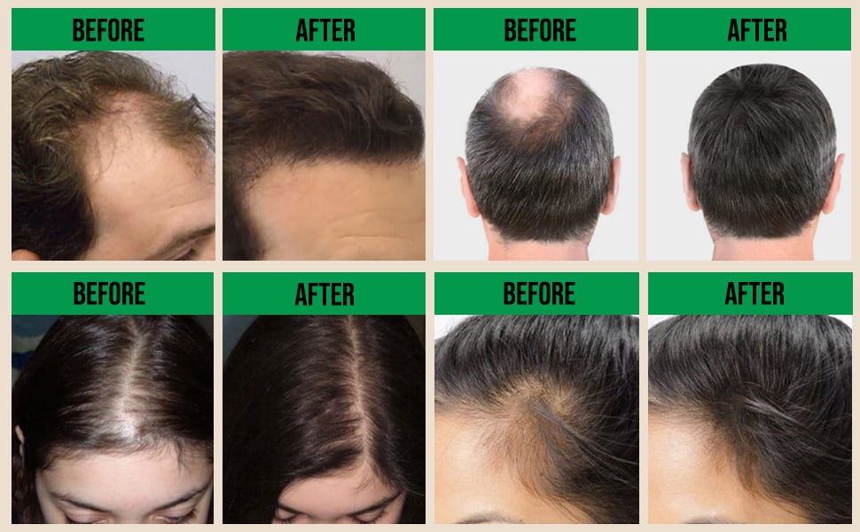 Picture of 7 Day Ginger Hair Growth Essence Germinal Serum Essence Oil Natural Hair Loss Treatement Effective Fast Growth Hair Care -50ML-Multicolor, Random Color