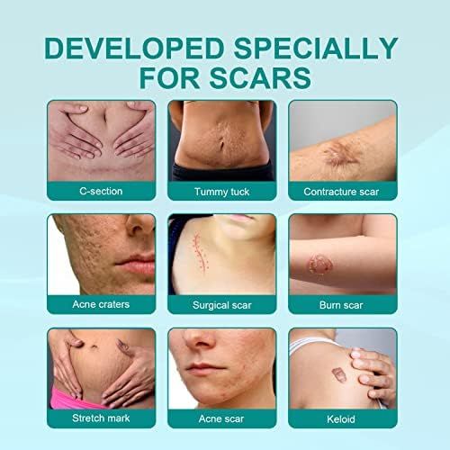 Picture of South Moon Medical Grade Scar Spray Good quality