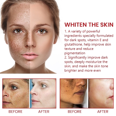 Picture of Dark Spot Remover For Face & Body Age Spot Brown Spot Sun Spot & Freckle Remover Cream spary- Multicolor