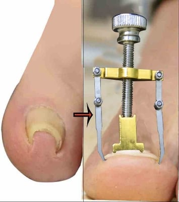Picture of Ingrown Toenail Correction Tool Foot Toe Nail Care Clip Brace Pedicure Treatment-Multicolor