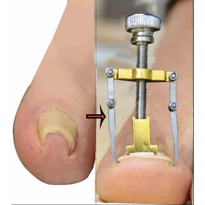 Picture of Ingrown Toenail Correction Tool Foot Toe Nail Care Clip Brace Pedicure Treatment-Multicolor