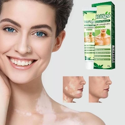 Picture of Vitiligo Treatment Cream Healthy White Spot Therapeutic Gel-Multicolor