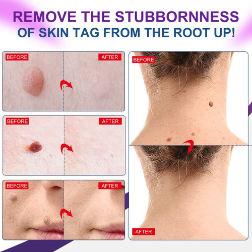 Picture of Skin Tag Remover Wart Remover Skin Tag Removal Quickly and Easily Remove Common Skin Tag Wart and Callus Effective and Scarless Suitable for All Skin Types Deep Care / 5ML / As Shown-NR Mart-2024 - Multicolor