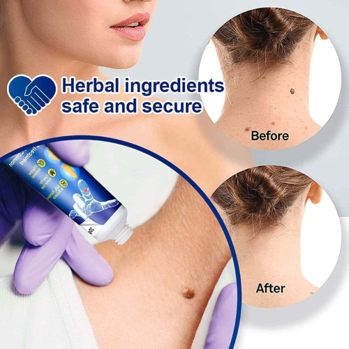 Picture of Warts Remover Ointment Wart Treatment Cream Skin Tag Remover Ointment -  Face - NR Mart-2024