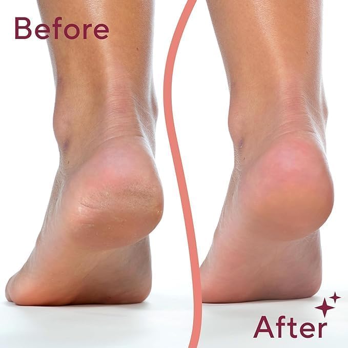 Picture of Electric Pedicure Device Foot Care Foot File with 2 Heads, Portable Callus and Dead Skin Remover, Foot Scrubber and Feet care Machine 