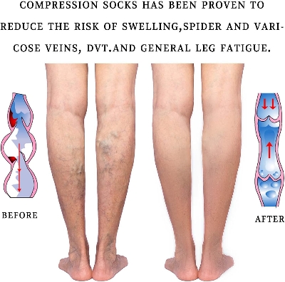 Picture of 20-30 mmHg Medical Compression Socks for Women and Men Knee High Open Toe Stockings Varicose Vein Swollen legs 