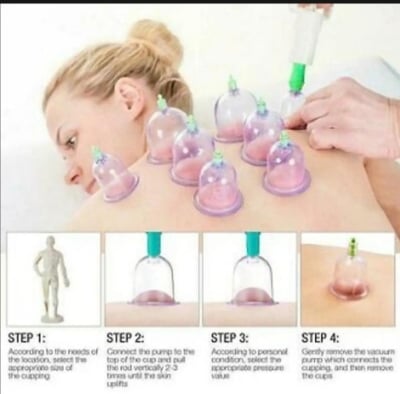 Picture of Hijama cupping Sunnah therapy 12psc set 
