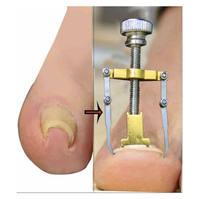 Picture of নখের কোনা সোজা করার অত্যাধুনিক যন্ত্র ( Nail Repair