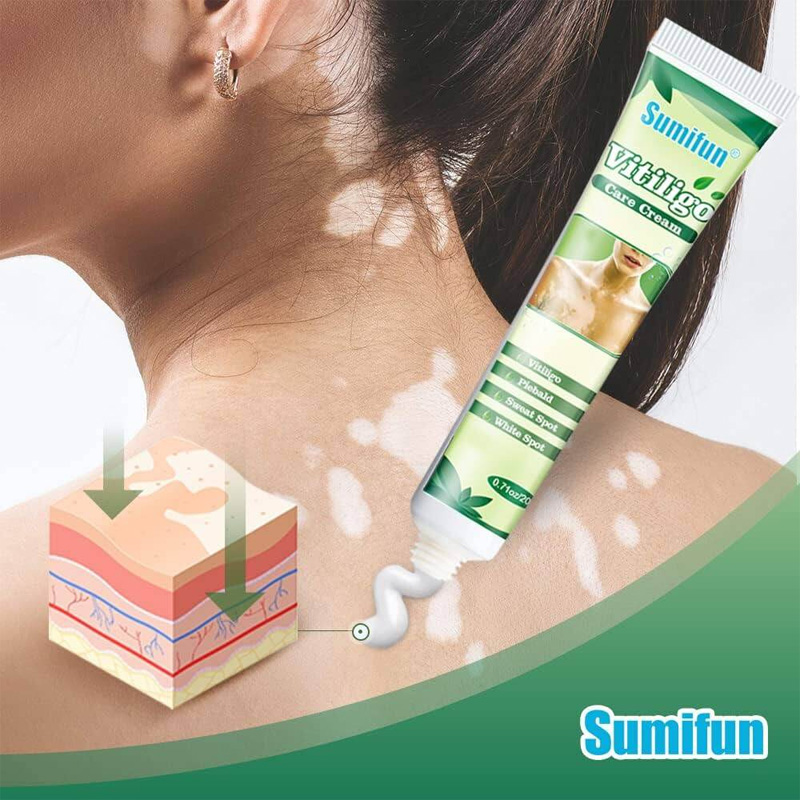 Picture of Sumifun Vitiligo Cream Reduces White Spots and Improves Skin Pigmentation-20gm