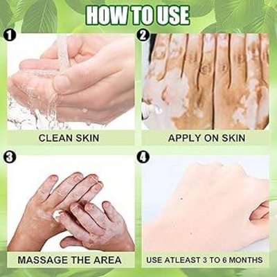 Picture of Sumifun Vitiligo Cream Reduces White Spots and Improves Skin Pigmentation-20gm